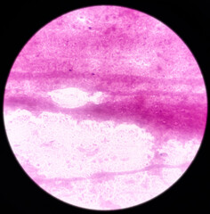 Microphotograph of breast lump, subareolar(FNA): Compatible with duct ectasia. smear show regular ductal epithelial cells on the background of proteinaceous material.