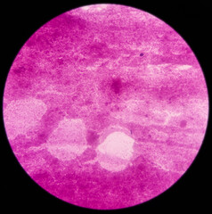 Microphotograph of breast lump, subareolar(FNA): Compatible with duct ectasia. smear show regular ductal epithelial cells on the background of proteinaceous material.