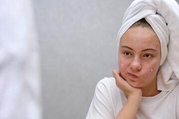 Acne treatment. A teenage girl twisted her face, which she does not like because of acne.
