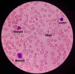 Microscopic image of macrocytic anaemia, folic acid deficiency, vitamin B12 deficiency. Macrocytic...