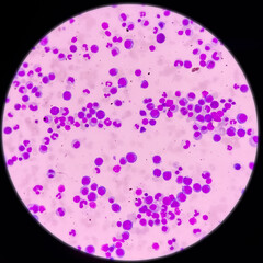 Microscopic view of bone marrow slide, megaloblastic anemia, mylodysplastic anemia, hyperactive and...