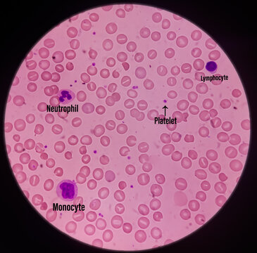 Microscopic image of macrocytic anaemia, folic acid deficiency, vitamin B12 deficiency. Macrocytic anemia is not a disease, show marking platelet and monocyte