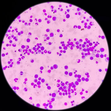 Microscopic view of bone marrow slide, megaloblastic anemia, mylodysplastic anemia, hyperactive and show normoblastic, early megaloblastic maturation, MDS disease