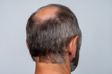 A closeup of a half-bald male head, hair transplant concept for hair loss
