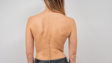 Woman with scoliosis of the spine. Curved woman's back with acne skin. - obrazy, fototapety, plakaty