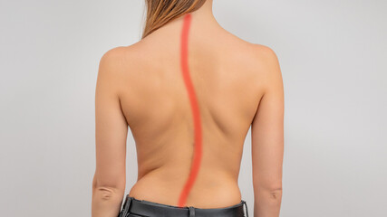 Woman with scoliosis of the spine. Curved woman's back. - obrazy, fototapety, plakaty