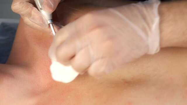 Surgeon removing moles and acne on man's chest using laser in hospital, hands in gloves closeup. Remove nevus on chest. One day surgery concept. Sore and wound after operation.