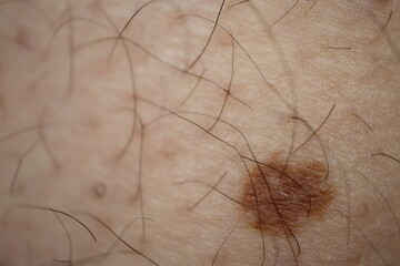 big brown skin mole on male caucasian skin