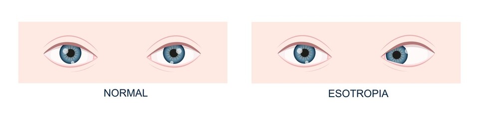 Esotropia. Horizontal strabismus before and after surgery. Eye misalignment, cross-eyed condition. Human eyes healthy and with inward gaze position. Double vision. Vector cartoon illustration - obrazy, fototapety, plakaty