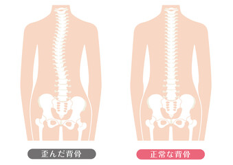 人間の体 正常な背骨と歪んだ背骨	
