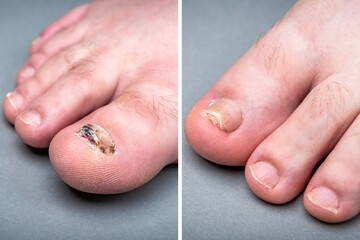 Before and after treatment for fungal infection on toenail. - obrazy, fototapety, plakaty