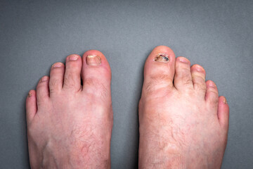 Onychomycosis fungal infection of toenail. Sick nail on the foot after damaging with tight shoes.