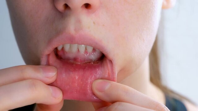 Stomatitis in woman's mouth after dental treatment, disease in the mouth. Stomatitis on the lower lip. Large ulcers in the mouth under the lower teeth. Treatment and diseases of the oral cavity.