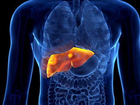 3d rendered illustration of liver cancer