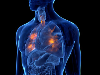 3d rendered illustration of lung cancer