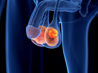3d rendered illustration of testis cancer © Sebastian Kaulitzki