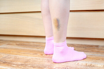 Bruised leg close up.