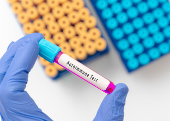 Obraz premium Biochemistry Blood sample for autoimmune test