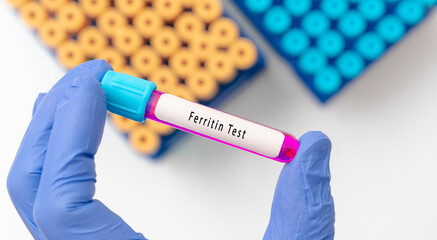Ferritin test result with blood sample in test tube on doctor hand in medical lab