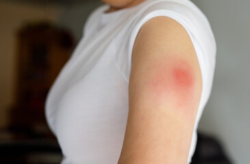 Vaccination reaction on arm of woman after injection of covid corona virus vaccine. Swollen part,...