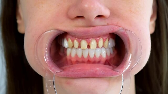 Mouth of woman with yellow bad teeth preparing to install ceramic veneers. Teeth sharpened by dentist before installing crowns and veneers. Dentistry treatment, prosthetics of teeth concept.