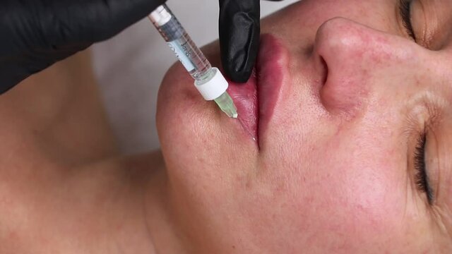 Lower lip augmentation and volume with fillers in a beauty salon