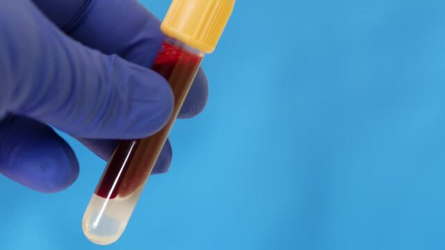 Container of human blood. Hand in blue nitrile glove holds test tube containing sample of human venous blood. Lab technician is holding test tube. Health care worker receives blood for analysis