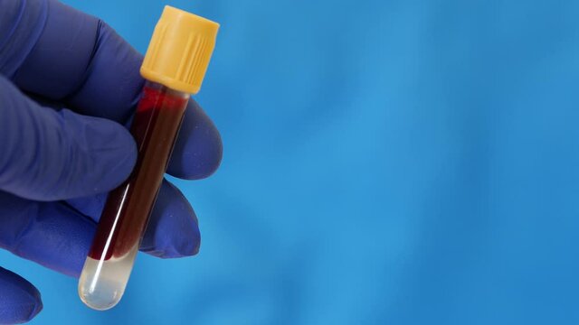 Container of human blood. Hand in blue nitrile glove holds test tube containing sample of human venous blood. Lab technician is holding test tube. Health care worker receives blood for analysis