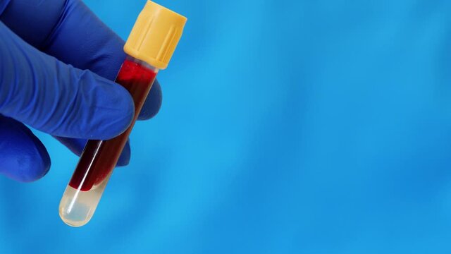 Container of human blood. Hand in blue nitrile glove holds test tube containing sample of human venous blood. Lab technician is holding test tube. Health care worker receives blood for analysis