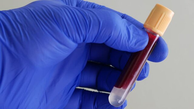 Container of human blood. Hand in blue nitrile glove holds test tube containing sample of human venous blood. Lab technician is holding test tube. Health care worker receives blood for analysis