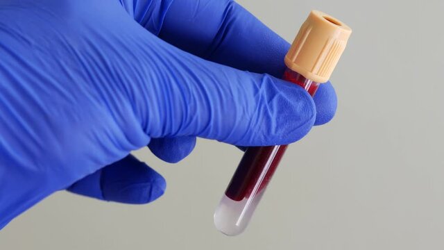 Container of human blood. Hand in blue nitrile glove holds test tube containing sample of human venous blood. Lab technician is holding test tube. Health care worker receives blood for analysis