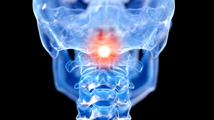 3d rendered illustration of a painful atlas vertebrae