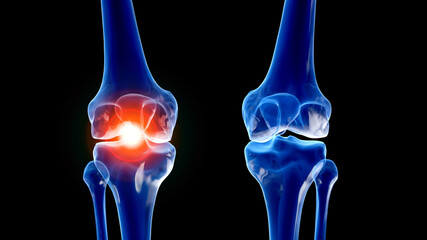 3d rendered illustration of a painful knee joint - obrazy, fototapety, plakaty