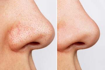 Close-up of woman's nose with blackheads or black dots before and after peeling and cleansing the...