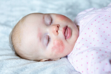 Little girl with atopic dermatitis on face - obrazy, fototapety, plakaty