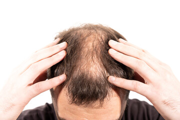 Fototapeta premium Close-up balding head of a young man on a white isolated background.