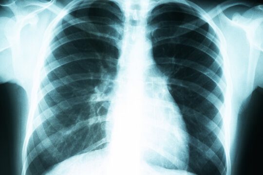X-ray of the lungs, radiological examination of chest diseases
