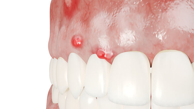3d rendered illustration of a dental abcess