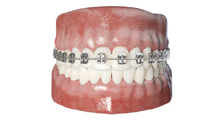 3d rendered illustration of dental braces
