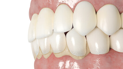 3d rendered illustration of a dental calculus