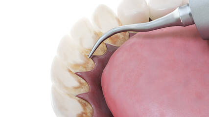 3d rendered illustration of a dental cleaning process