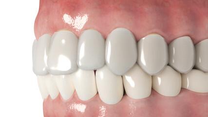 3d rendered illustration of a clear dental aligner