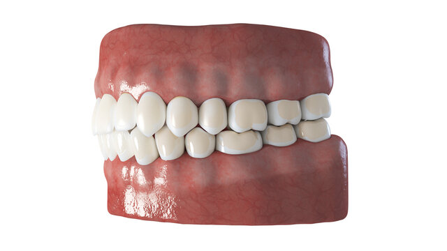 3d rendered illustration of dental demineralization