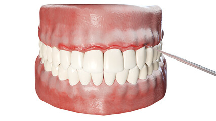 3d rendered illustration of a fiberotomy