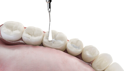 3d rendered illustration of a dental fissure filling