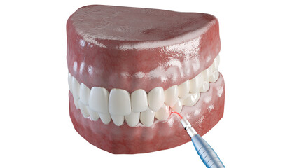 3d rendered illustration of a dental gum correction