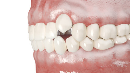 3d rendered illustration of impacted incisors