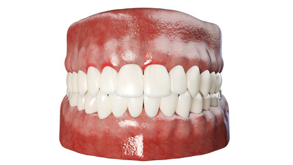 3d rendered illustration of a peridontal disease