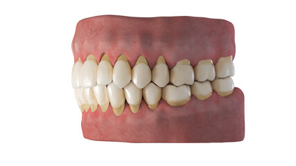 3d rendered illustration of periodontitis