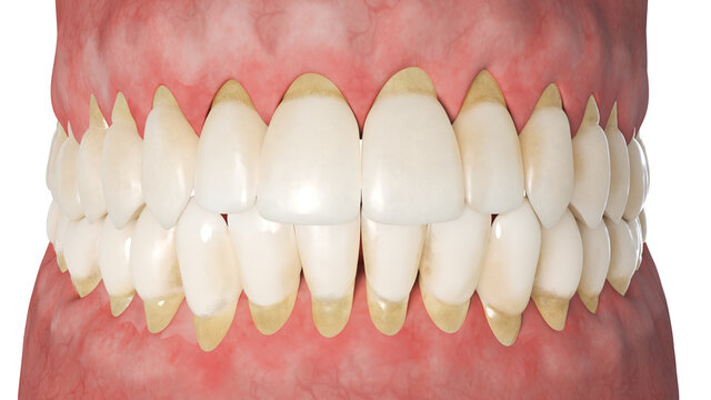3d rendered illustration of periodontitis
